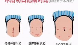 成都日报锦观新闻：全省首例！治疗直肠癌不切肚子、不“挂袋”