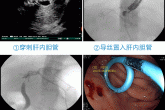 我院开展首例超声内镜引导下胆管引流术