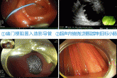 超声内镜引导下胃肠造口术，为患者打开新的生命通道