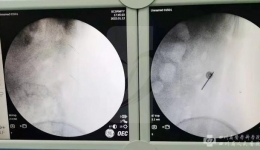 在C型臂X光机的帮助下采用微创腹腔镜手术顺利为患者取出绣花针