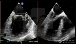 我院采用微创方法救治一例严重二尖瓣关闭不全的患者