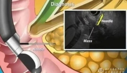 一针定乾坤！内镜三大技术超微创解决胰腺癌难题！