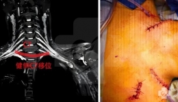 神经移位术，13岁少年左手瘫痪6个月后迎来新希望！