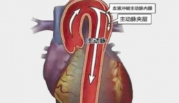 小心！别让血管变夹心饼干！