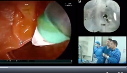 今日头条：全程可视化 四川省人民医院首创硬核术式保住胆结石孕妈妈腹中胎儿