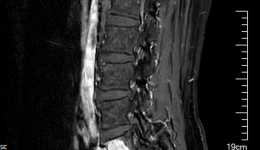 攻克脊柱外科“手术禁区”，我院骨科成功实施高难度腰5椎体全切术