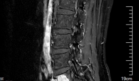 攻克脊柱外科“手术禁区”，我院骨科成功实施高难度腰5椎体全切术