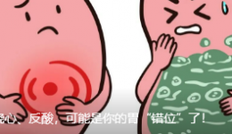 长期烧心、反酸，可能是你的胃“错位”了！