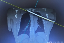 钢筋穿胸命悬一线，我院多学科专家协作挽救患者生命