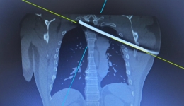 钢筋穿胸命悬一线，我院多学科专家协作挽救患者生命