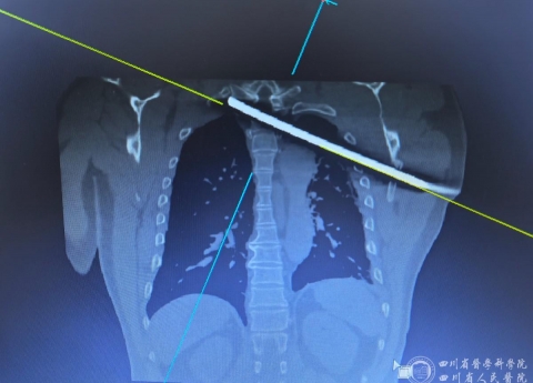 钢筋穿胸命悬一线，我院多学科专家协作挽救患者生命