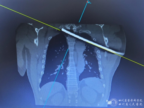 钢筋穿胸命悬一线，我院多学科专家协作挽救患者生命