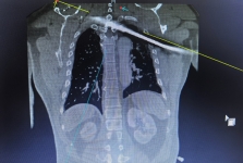 今日头条：钢筋穿胸命悬一线 四川省人民医院多学科专家协作挽救患者生命