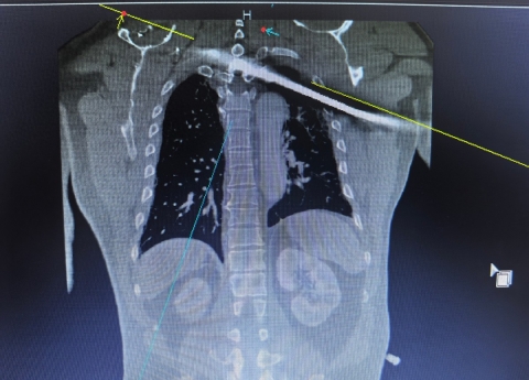 今日头条：钢筋穿胸命悬一线 四川省人民医院多学科专家协作挽救患者生命