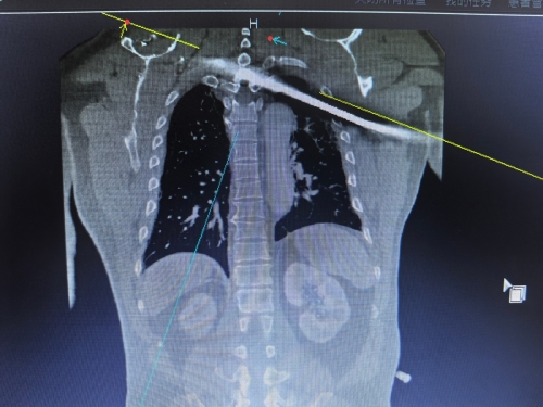 今日头条：钢筋穿胸命悬一线 四川省人民医院多学科专家协作挽救患者生命