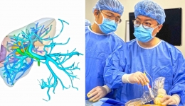 西南首例！超声医学科介入超声诊疗中心成功开展经皮超声引导纳米刀+腔镜超声引导微波消融治疗肝癌