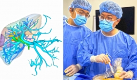 西南首例！超声医学科介入超声诊疗中心成功开展经皮超声引导纳米刀+腔镜超声引导微波消融治疗肝癌