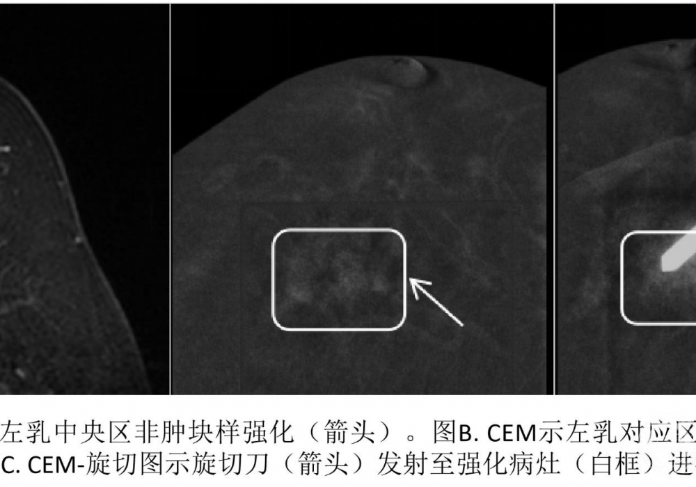 西南首发，我院成功开展乳腺CEM引导下真空辅助旋切活检