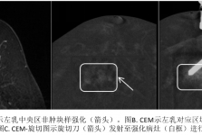 西南首发，我院成功开展乳腺CEM引导下真空辅助旋切活检