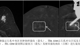 西南首发，我院成功开展乳腺CEM引导下真空辅助旋切活检