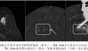 西南首发，我院成功开展乳腺CEM引导下真空辅助旋切活检