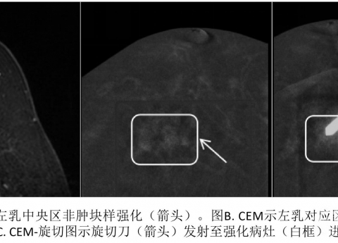 西南首发，我院成功开展乳腺CEM引导下真空辅助旋切活检