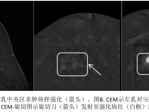 西南首发，我院成功开展乳腺CEM引导下真空辅助旋切活检