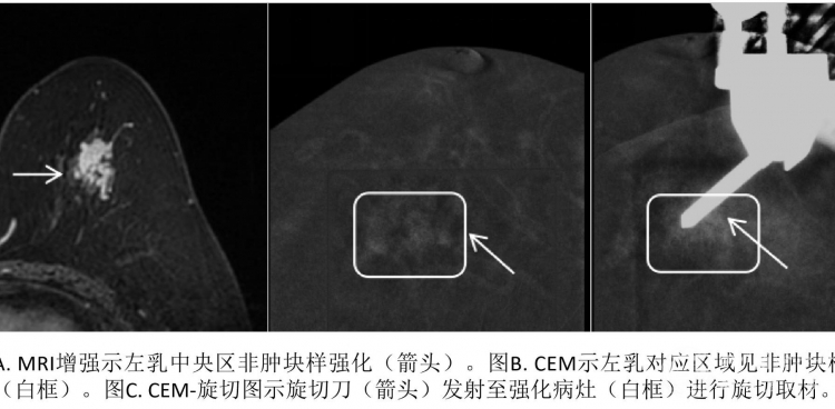 西南首发，我院成功开展乳腺CEM引导下真空辅助旋切活检
