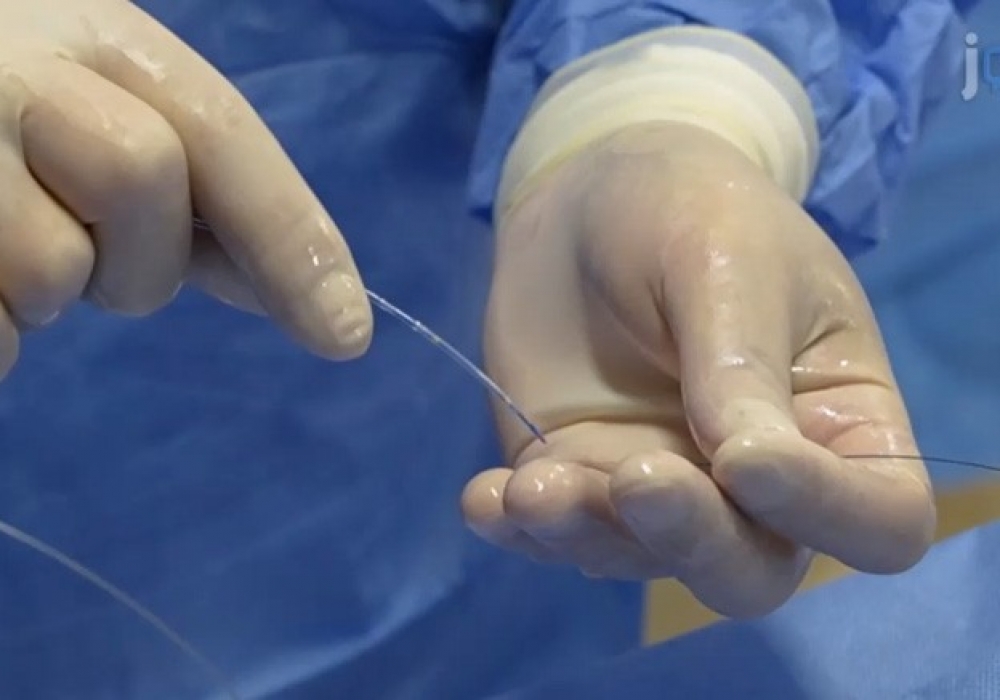 纤维性纵隔炎肺静脉狭窄介入治疗