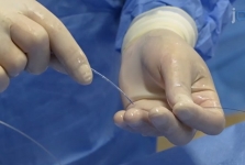 纤维性纵隔炎肺静脉狭窄介入治疗