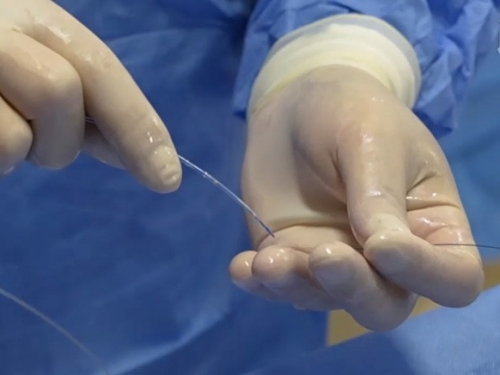 纤维性纵隔炎肺静脉狭窄介入治疗