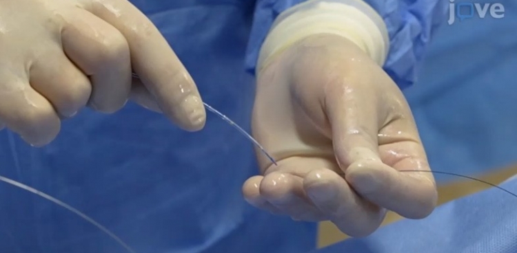 纤维性纵隔炎肺静脉狭窄介入治疗