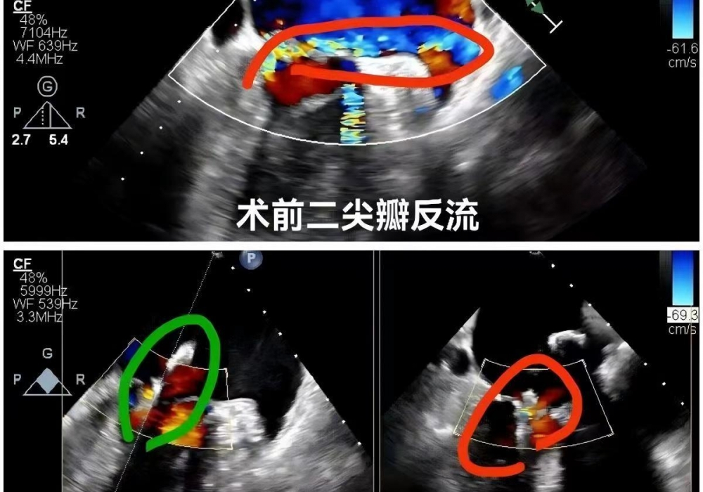 心脏外科中心完成省内首例零射线纯超声引导下二尖瓣修复术