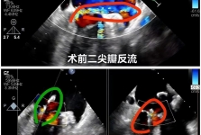 心脏外科中心完成省内首例零射线纯超声引导下二尖瓣修复术