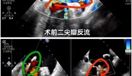 心脏外科中心完成省内首例零射线纯超声引导下二尖瓣修复术