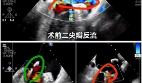 心脏外科中心完成省内首例零射线纯超声引导下二尖瓣修复术