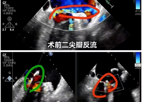 心脏外科中心完成省内首例零射线纯超声引导下二尖瓣修复术
