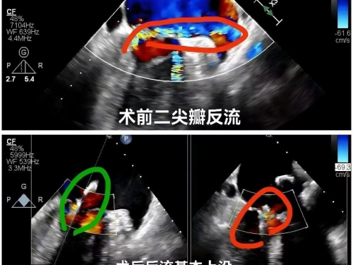 心脏外科中心完成省内首例零射线纯超声引导下二尖瓣修复术