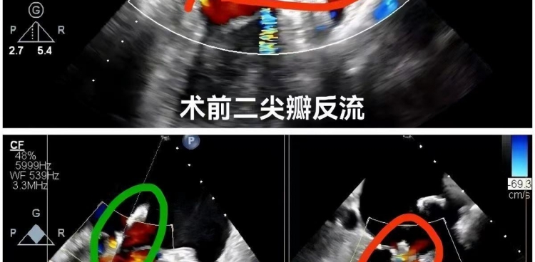 心脏外科中心完成省内首例零射线纯超声引导下二尖瓣修复术