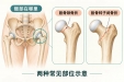 轻轻一摔就髋部骨折？老年人防跌倒，关键在这几件事